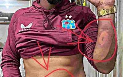 'The after effects' - After the fifth T20 match, Nicholas Pooran showed the scars on his?body?
